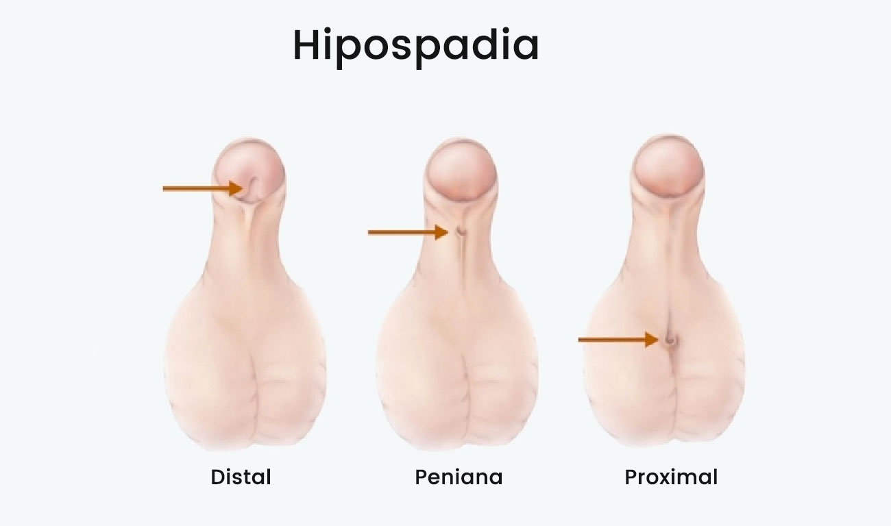 penis hipospadia